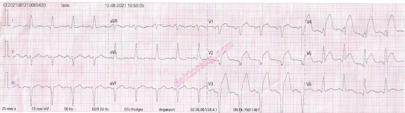 acute anterior myocardial infarction - akut ön duvar miyokard