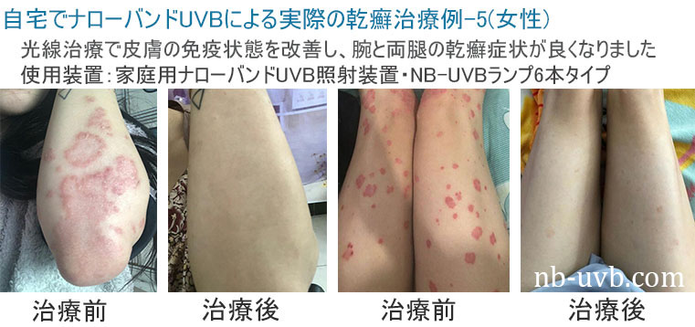 家庭用ナローバンドUVB(311nm)照射装置[個人輸入]｜在宅での(白斑